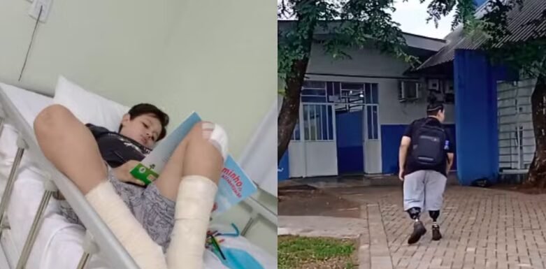  Criança de município da região se rala após cair de skate, contrai infecção generalizada e precisa amputar as duas pernas