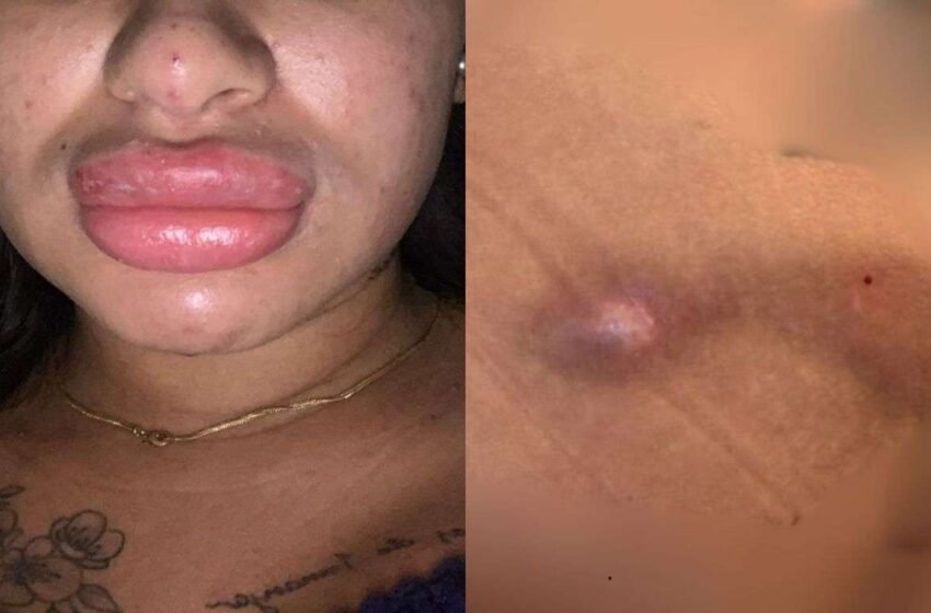  Mulheres ficam com sequelas após procedimentos estéticos feitos por falsa biomédica em SC
