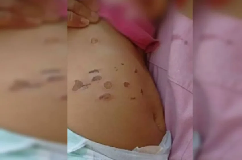  Bebê de 10 meses é vítima de agressões e sofre queimaduras pelo corpo