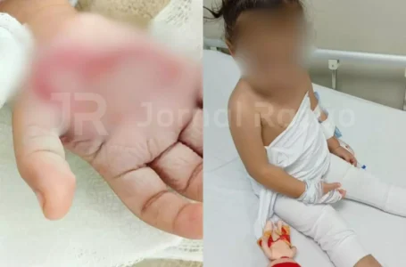 Madrasta queima mão de criança de 2 anos como forma de vingança